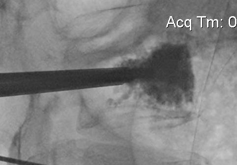 Kyphoplasty cement Lateral